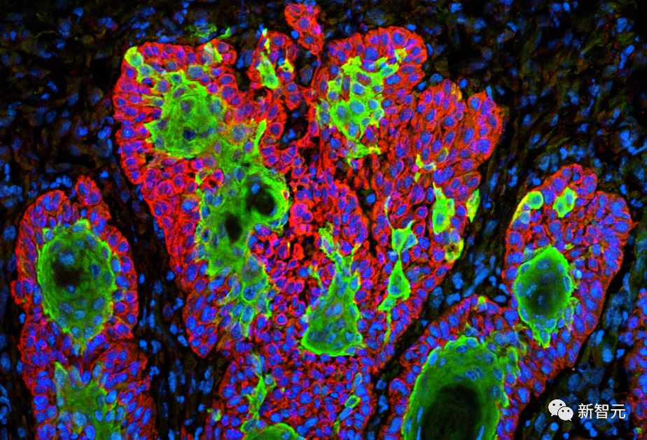 Nature子刊：AI算法破解癌细胞基因特征，准确率可达99%！
