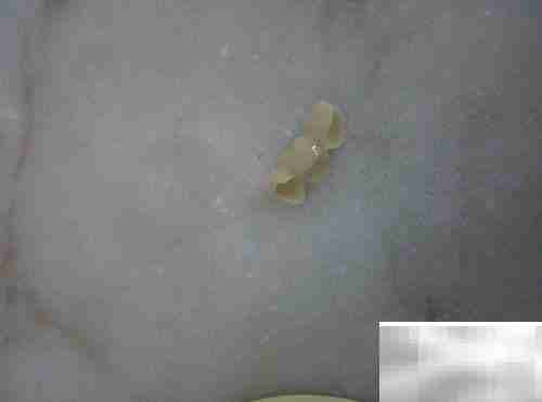 固定义齿与活动义齿对比