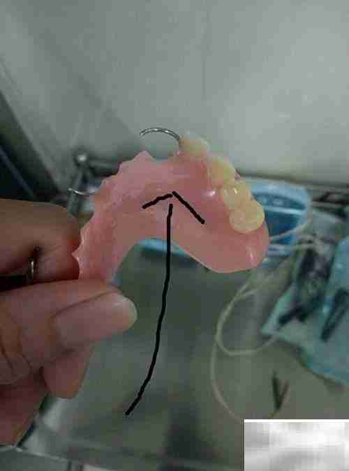 固定义齿与活动义齿对比