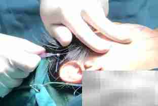 面部悬吊提升恢复时间