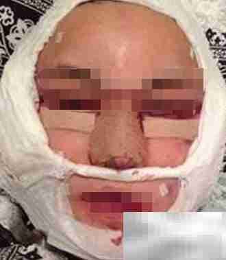 面部悬吊提升恢复时间