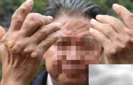 痛风高发人群有哪些？