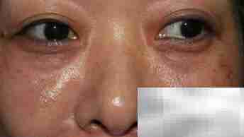 自体脂肪填充致脸歪？