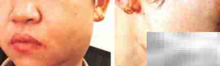 自体脂肪填充致脸歪？